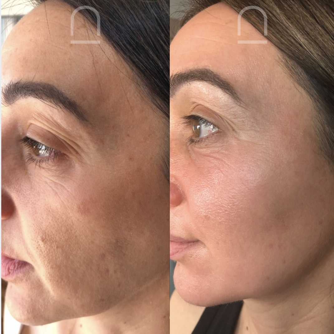 Client before and after skin treatment 3