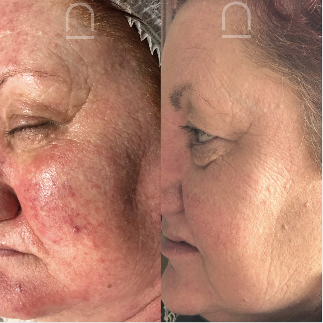 Client before and after skin treatment 5