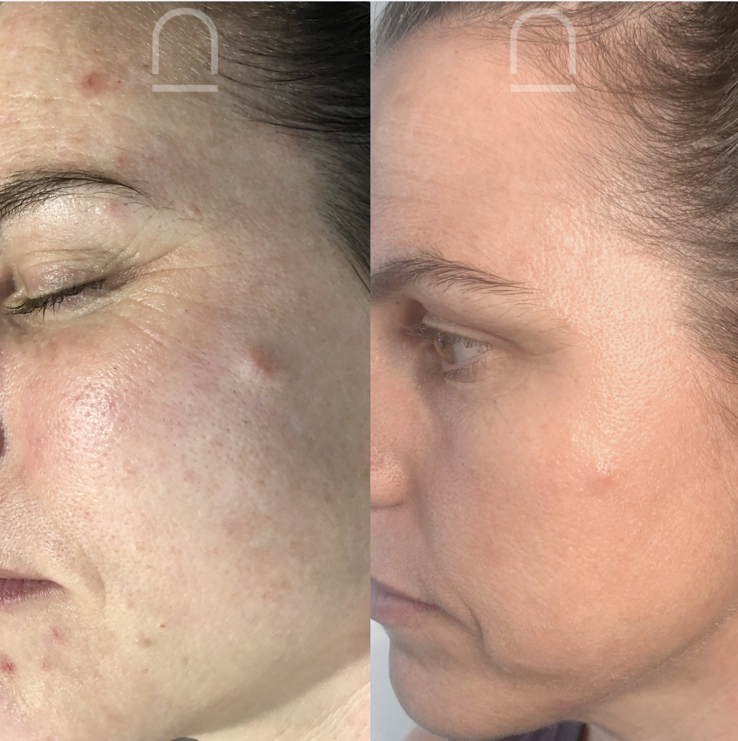 Client before and after skin treatment 4