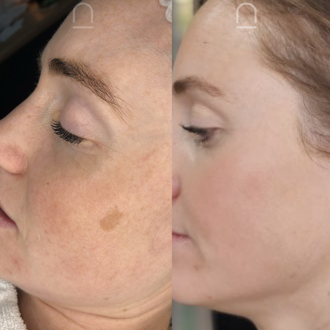 Client before and after skin treatment 6