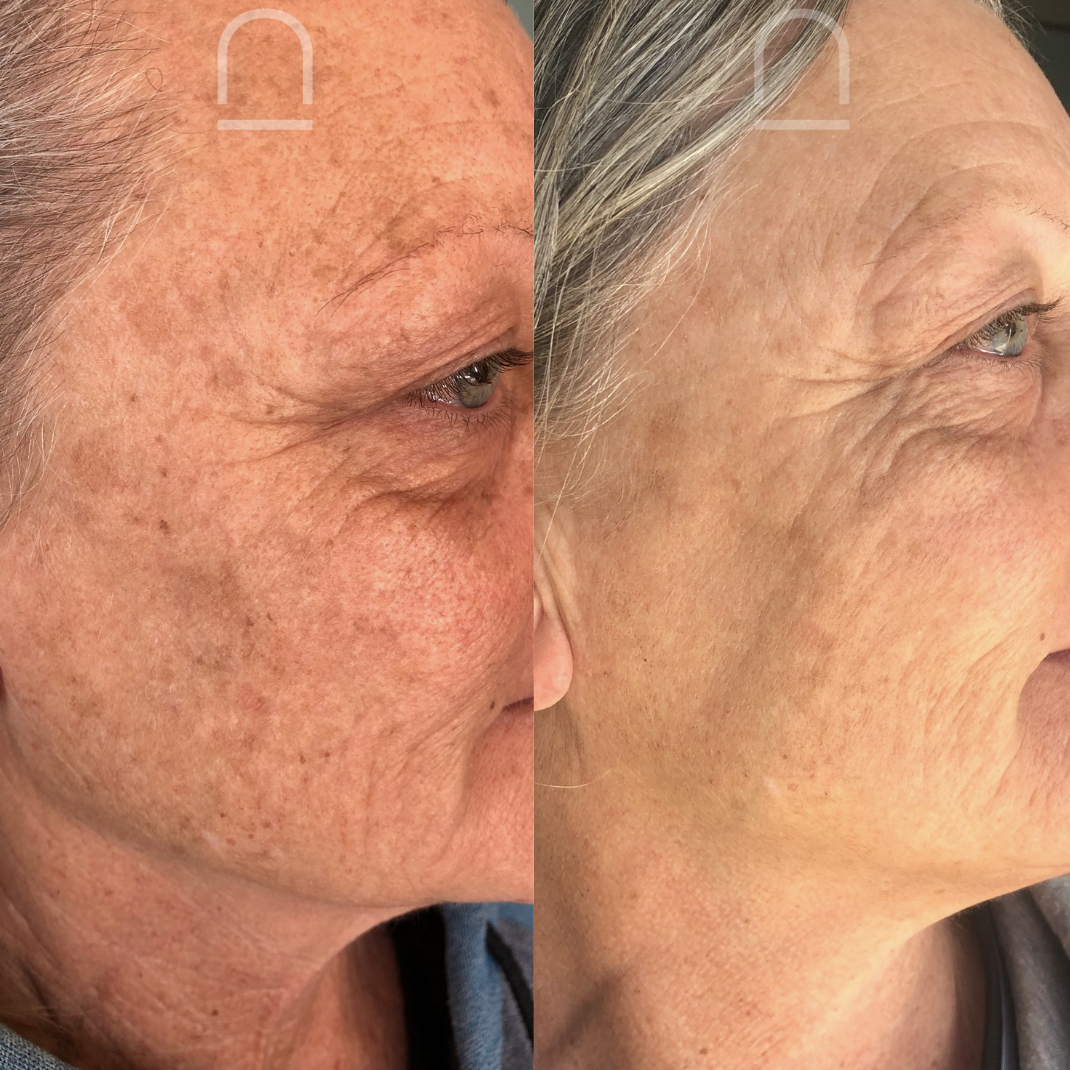 Client before and after skin treatment 2