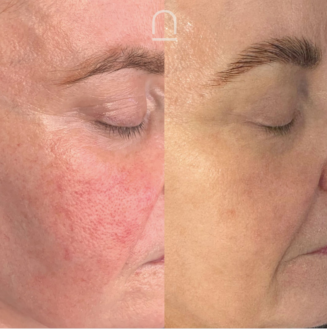Client before and after skin treatment 1